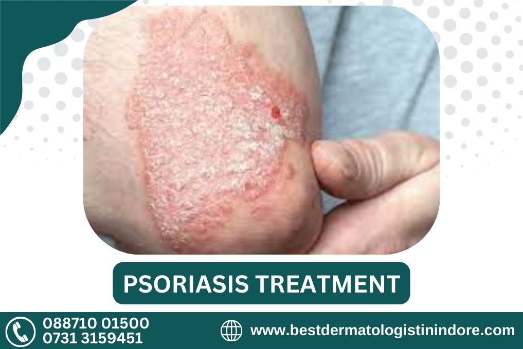 Best Skin Specialist for Psoriasis in Indore